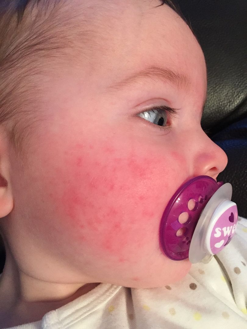 Baby Has Rash On Face What Could It Be Pic Babycentre